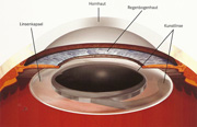 Die Kunstlinse nimmt im Auge den Platz der getrübten menschlichen Linse ein.